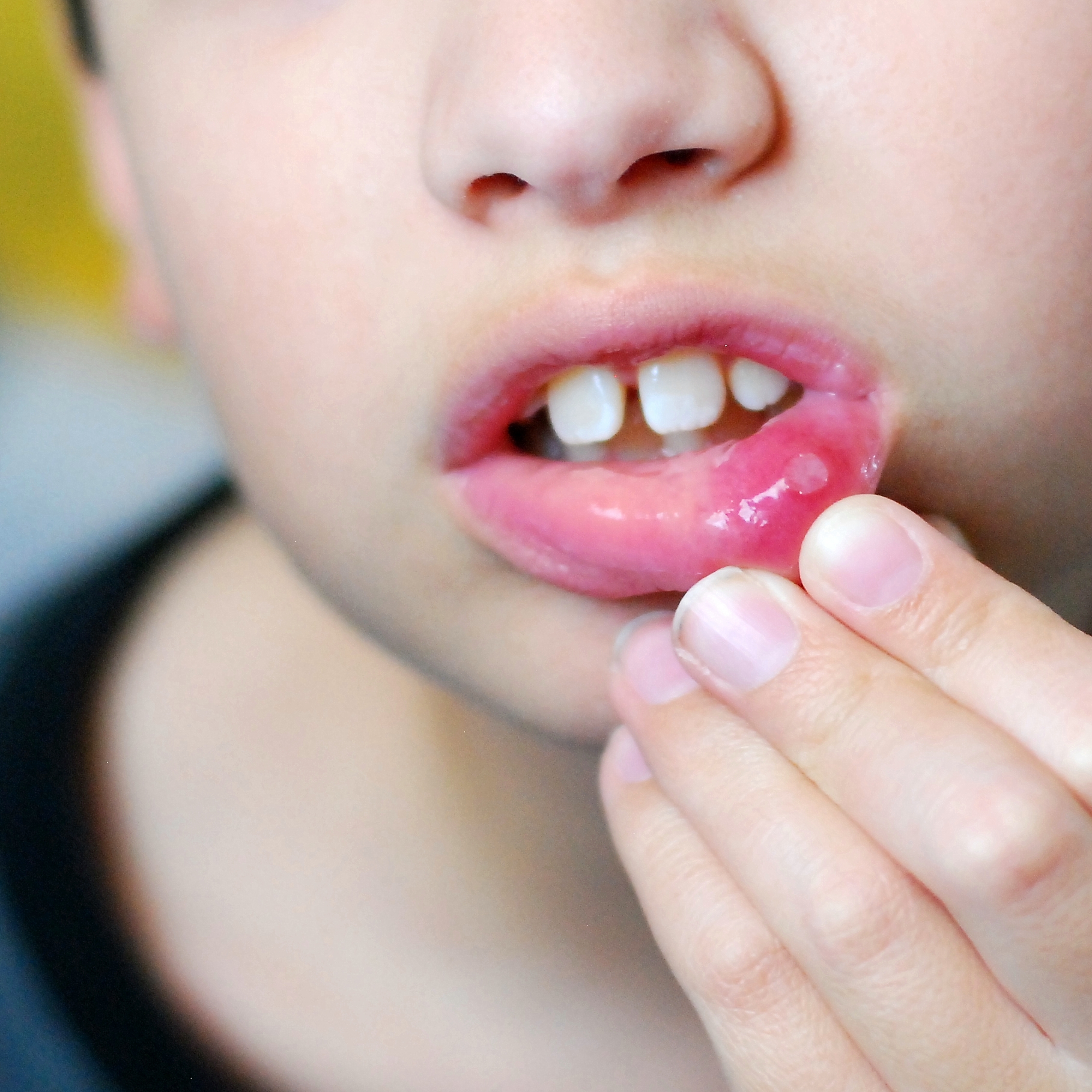 Mouth Ulcer Treatment And Prevention