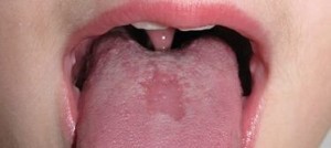 pfapa mouth ulcer healing stage