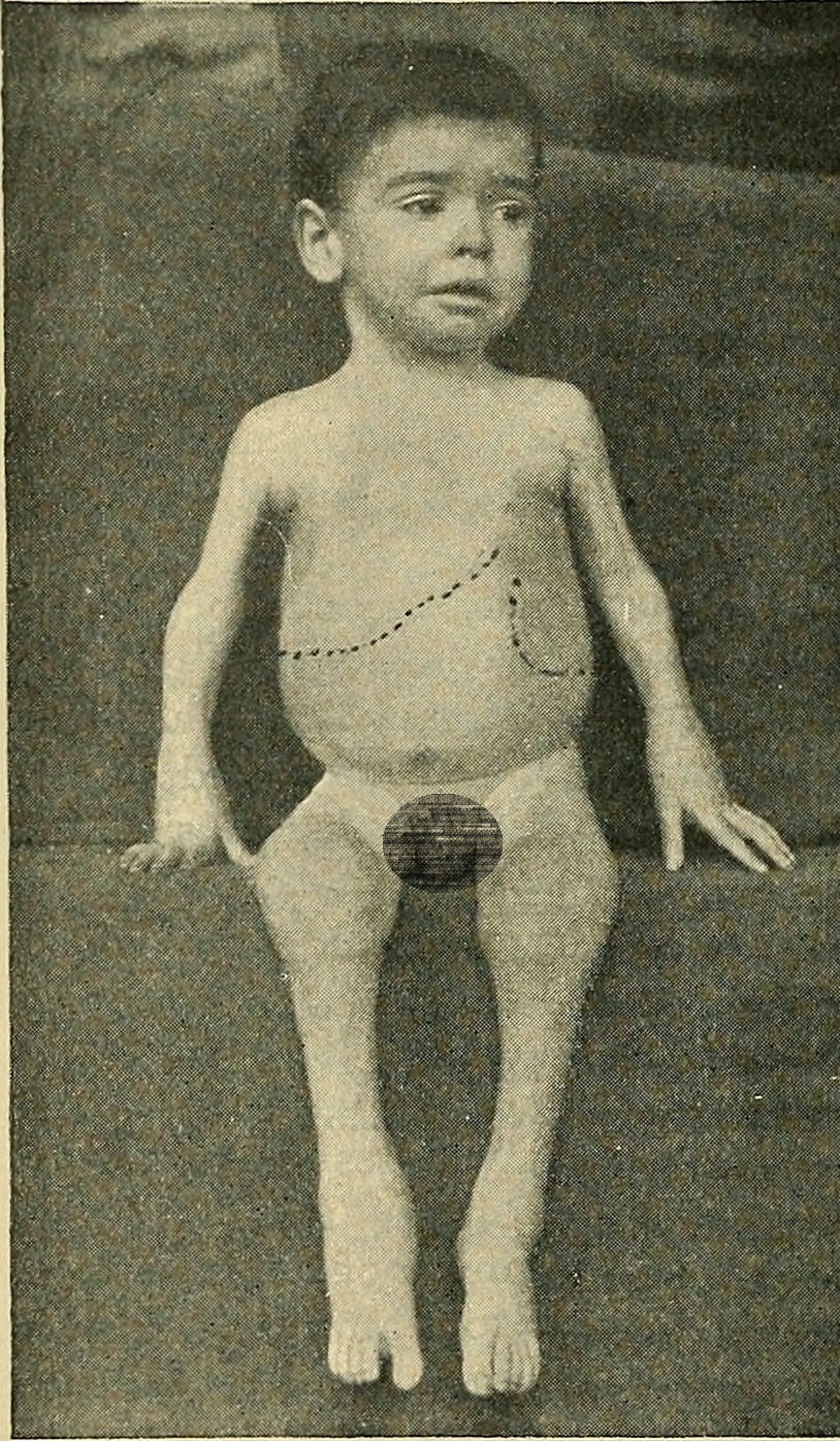 This photo from a medical book published in 1900 shows a child with Still's disease, also known now as SJIA. Without treatment children with SJIA suffer from severely swollen joints, swollen lymph nodes, pleurisy, and may other systemic inflammatory symptoms. This condition is progressive without targeted treatment that stops the inflammatory process - these medications were not available to this child in 1900. The dotted line shows the extent of the swelling of the liver and spleen.